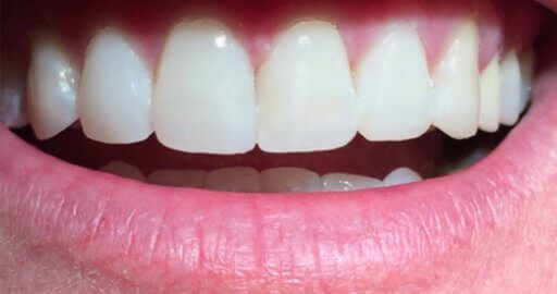 Before and After' Teeth Repair Results